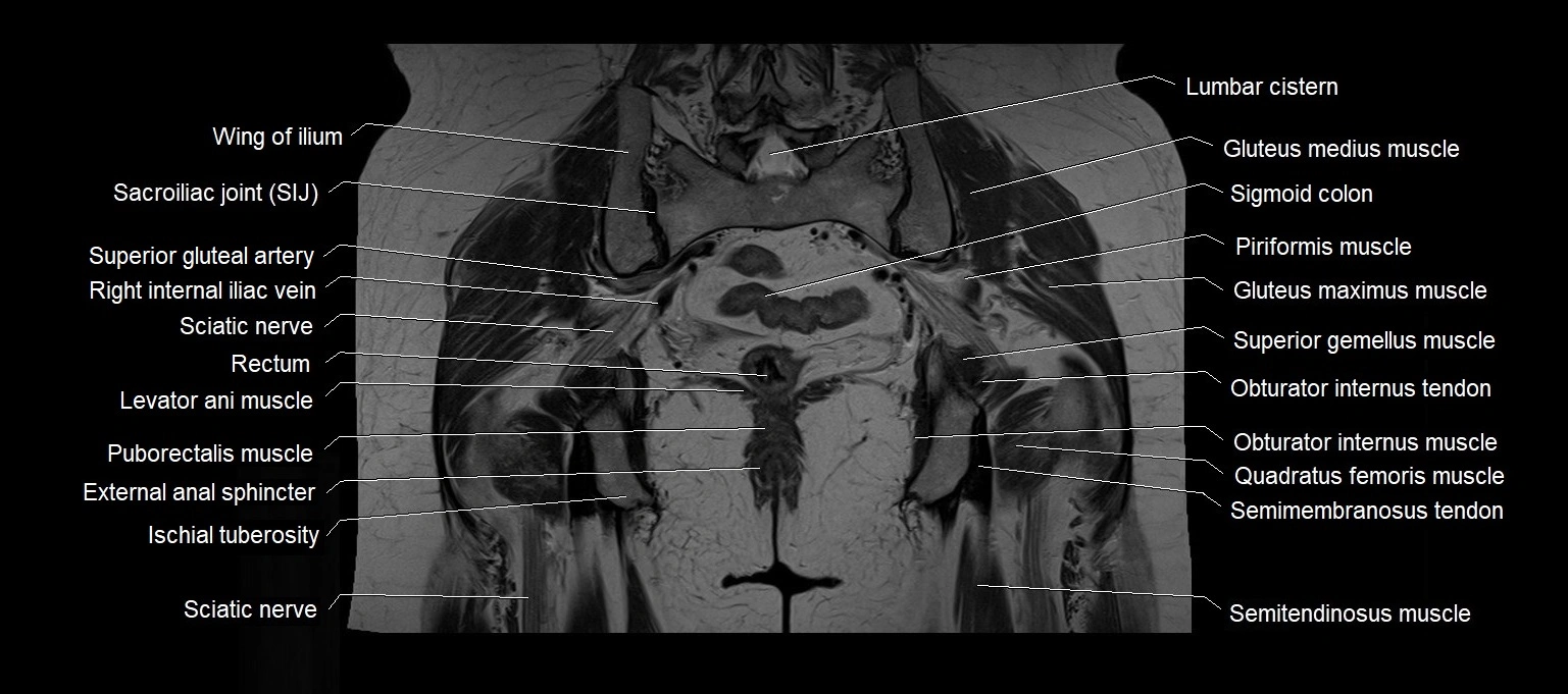MRI 3T pelvis coronal cross section anatomy image 19.webp